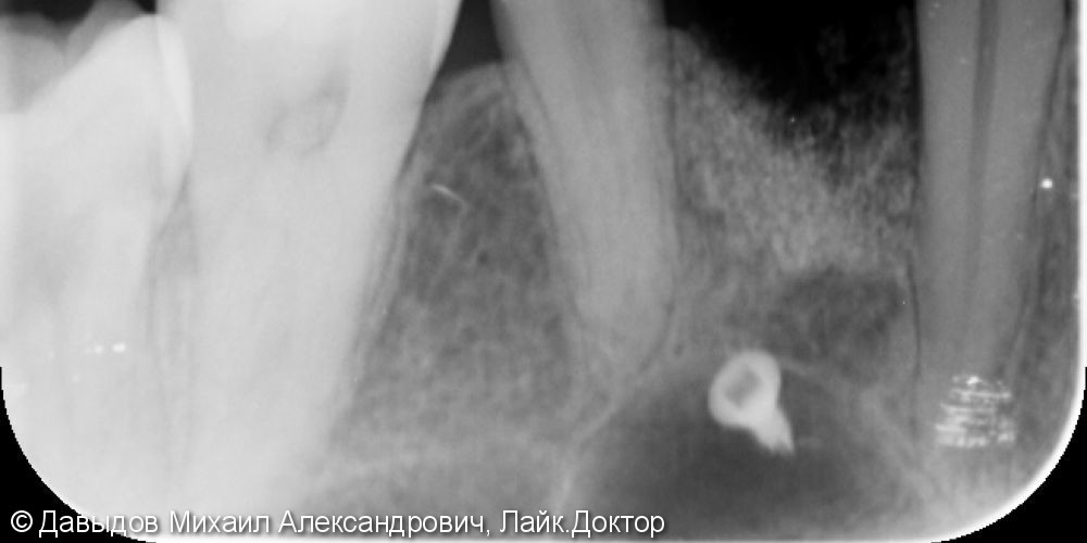 Операция имплантации зуба 24 - фото №2
