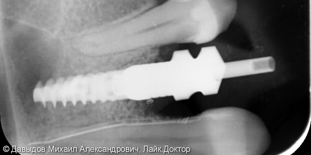 Операция имплантации зуба 24 - фото №3