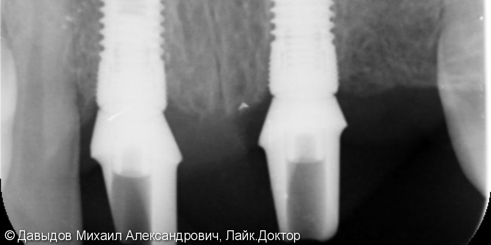 Имплантация двух центральных резцов верхней челюсти с немедленной нагрузкой. - фото №2