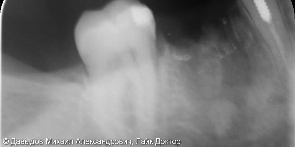 Простая имплантация зуб 46 - фото №1