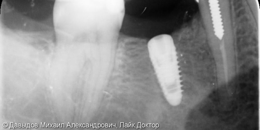 Простая имплантация зуб 46 - фото №2