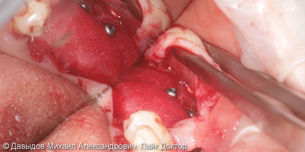Операция увеличения толщины альвеолярного гребня с удалением корней для дальнейшей имплантации. - фото №4