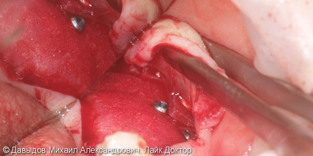 Операция увеличения толщины альвеолярного гребня с удалением корней для дальнейшей имплантации. - фото №5