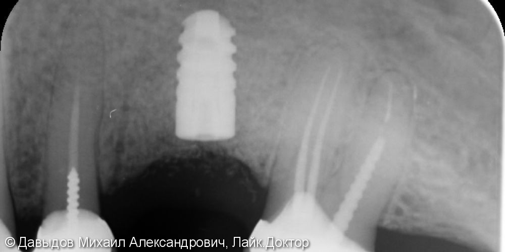 Восстановление целостности зубного ряда при помощи металлокерамической коронки на одиночный имплантат - фото №1