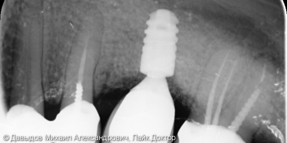 Восстановление целостности зубного ряда при помощи металлокерамической коронки на одиночный имплантат - фото №2
