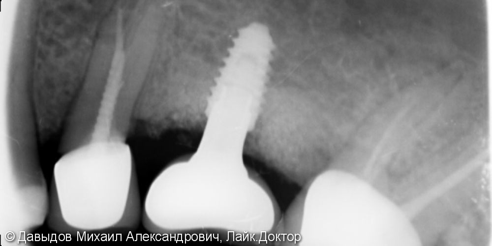 Восстановление целостности зубного ряда металлокерамической коронкой на импланте - фото №2