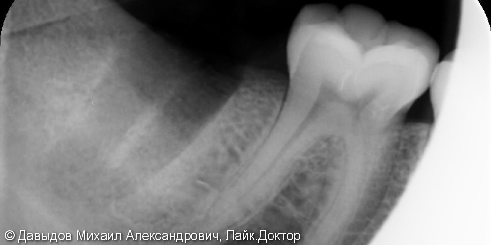 Одномоментная имплантация зуба 4.7 - фото №1