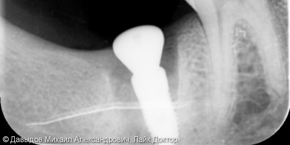 Одномоментная имплантация зуба 4.7 - фото №3