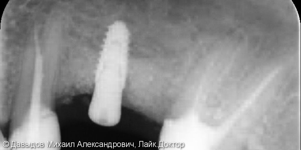 Восстановление целостности зубного ряда металлокерамической коронкой на импланте - фото №1