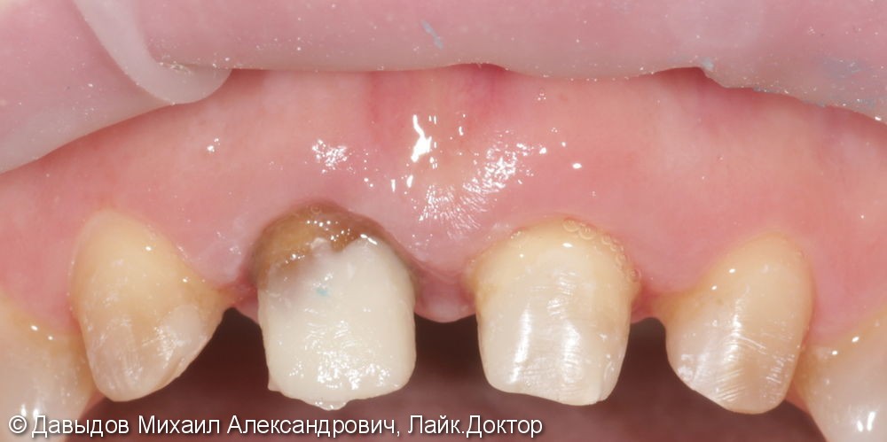 Бюджетное протезирование фронтальной группы зубов коронками из диоксида циркония - фото №1