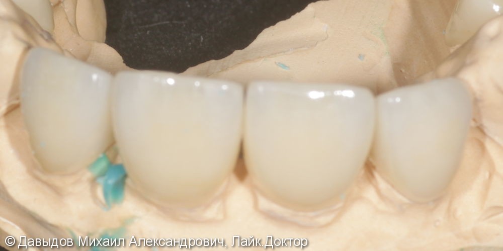 Бюджетное протезирование фронтальной группы зубов коронками из диоксида циркония - фото №2