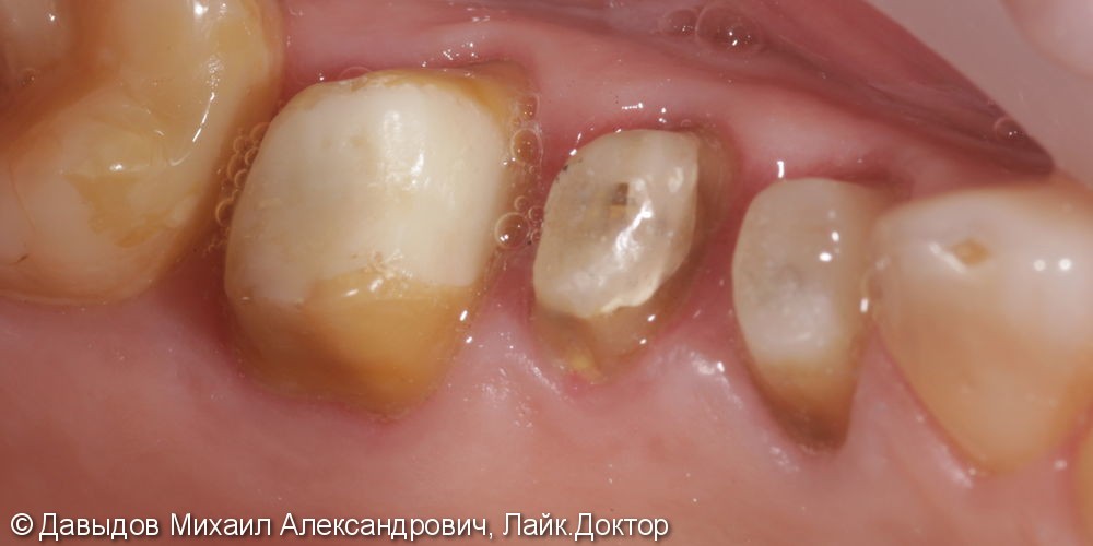 Протезирование жевательной группы зубов. - фото №1