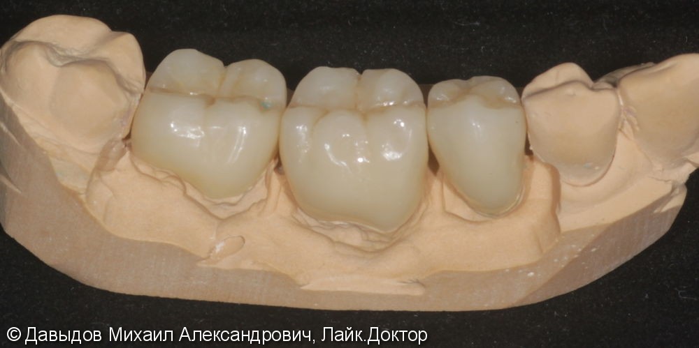 Протезирование жевательной группы зубов. - фото №2