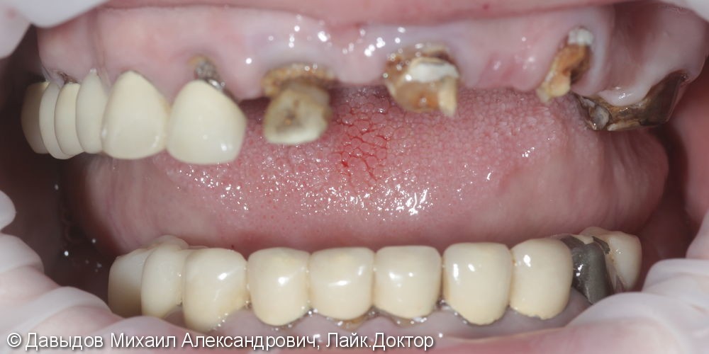 Протезирование зубов верхней челюсти условно-сьемным металлокомпозитным протезом на имплантах ANKYLOS - фото №1