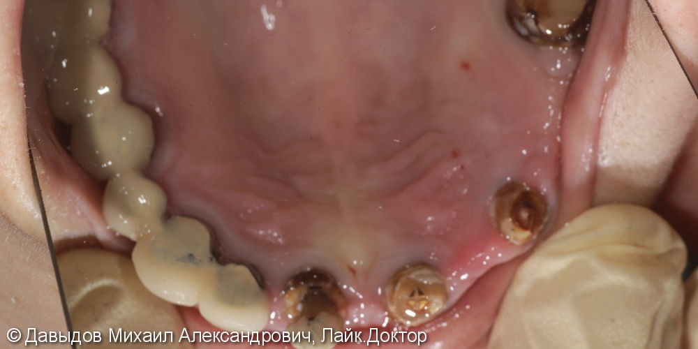 Протезирование зубов верхней челюсти условно-сьемным металлокомпозитным протезом на имплантах ANKYLOS - фото №2
