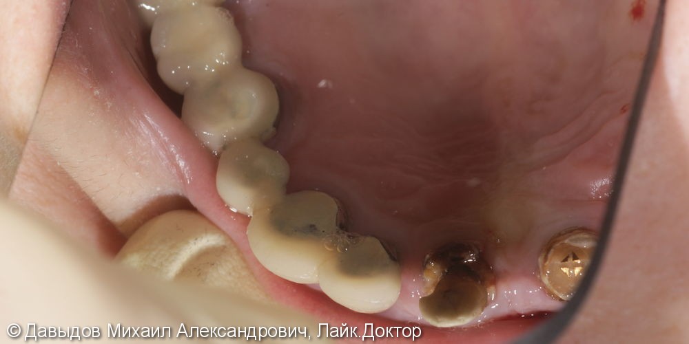 Протезирование зубов верхней челюсти условно-сьемным металлокомпозитным протезом на имплантах ANKYLOS - фото №3