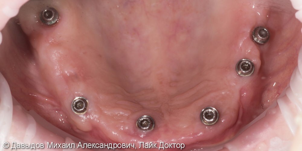 Протезирование зубов верхней челюсти условно-сьемным металлокомпозитным протезом на имплантах ANKYLOS - фото №4