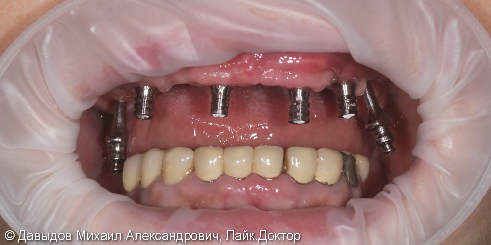 Протезирование зубов верхней челюсти условно-сьемным металлокомпозитным протезом на имплантах ANKYLOS - фото №5