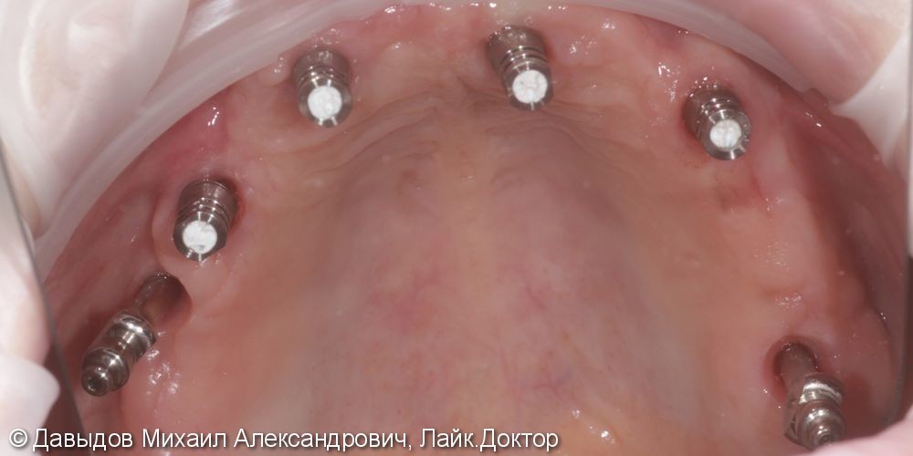 Протезирование зубов верхней челюсти условно-сьемным металлокомпозитным протезом на имплантах ANKYLOS - фото №6
