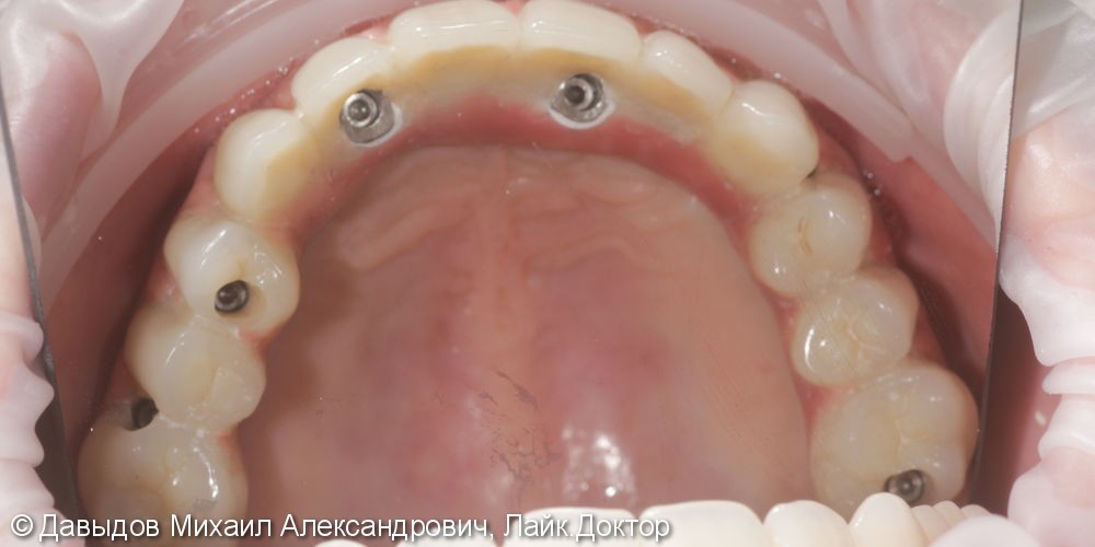 Протезирование зубов верхней челюсти условно-сьемным металлокомпозитным протезом на имплантах ANKYLOS - фото №8