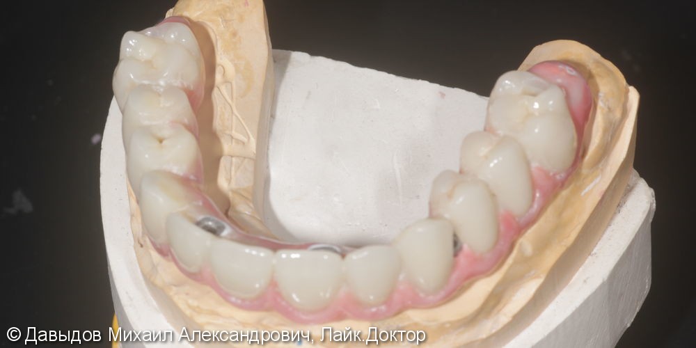 Протезирование зубов верхней челюсти условно-сьемным металлокомпозитным протезом на имплантах ANKYLOS - фото №9
