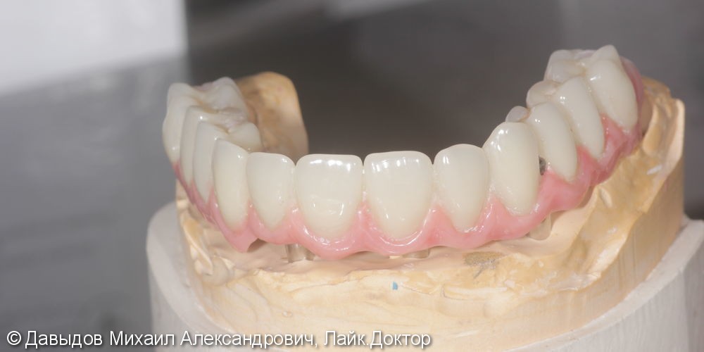 Протезирование зубов верхней челюсти условно-сьемным металлокомпозитным протезом на имплантах ANKYLOS - фото №10