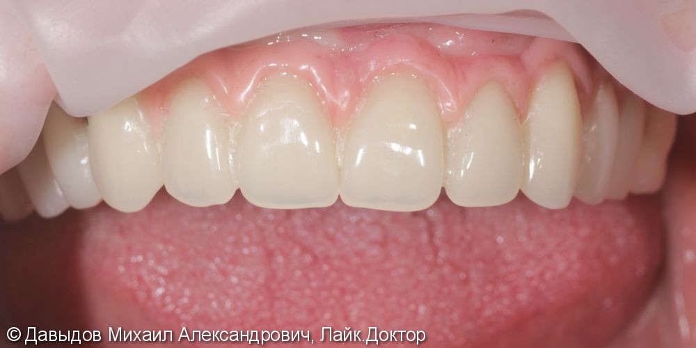 Протезирование зубов верхней челюсти условно-сьемным металлокомпозитным протезом на имплантах ANKYLOS - фото №11