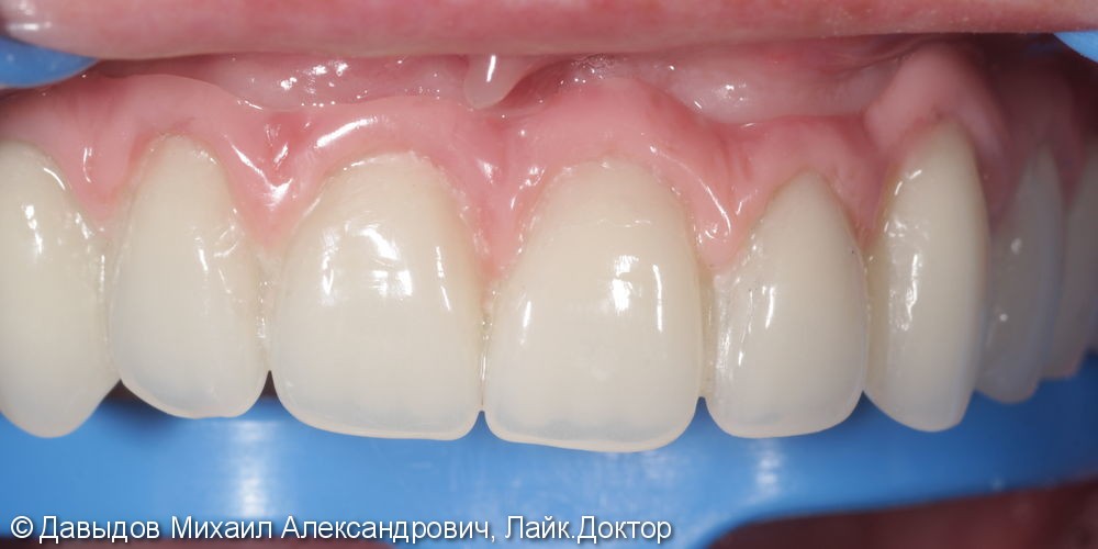 Протезирование зубов верхней челюсти условно-сьемным металлокомпозитным протезом на имплантах ANKYLOS - фото №12