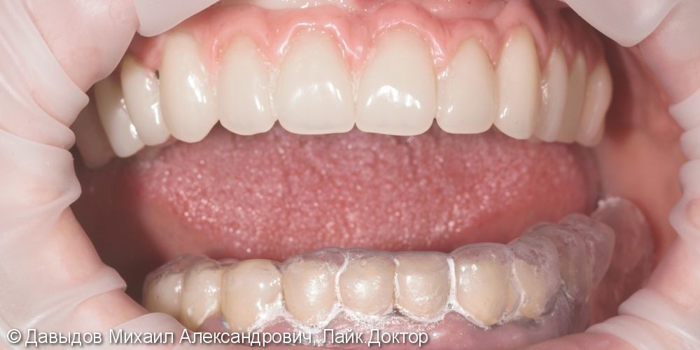 Протезирование зубов верхней челюсти условно-сьемным металлокомпозитным протезом на имплантах ANKYLOS - фото №13