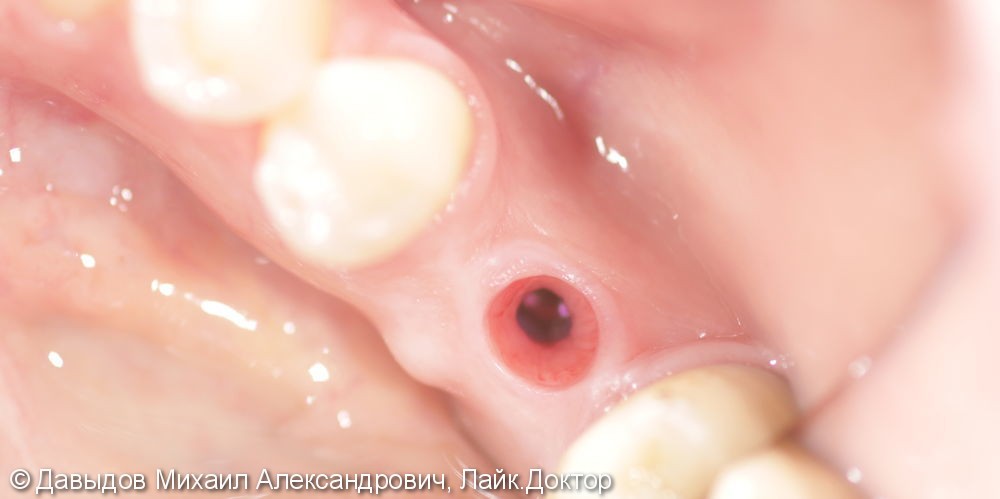 Протезирование недостающего зуба одиночной коронкой из диоксида циркония на импланте - фото №1