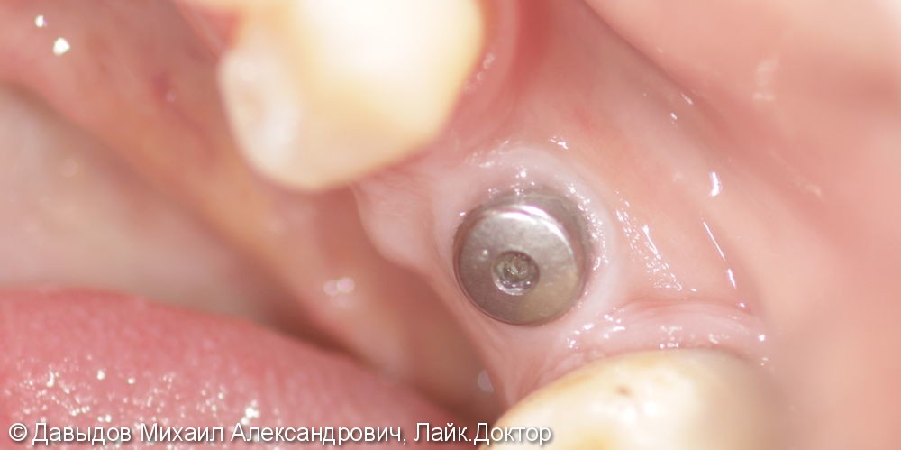 Протезирование недостающего зуба одиночной коронкой из диоксида циркония на импланте - фото №2