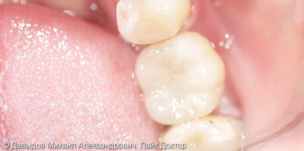 Протезирование недостающего зуба одиночной коронкой из диоксида циркония на импланте - фото №3
