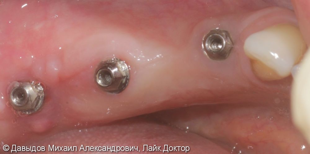 Восстановление концевого дефекта нижней челюсти протезом из диоксида циркония на мультиюнитах с винтовой фиксацией - фото №5