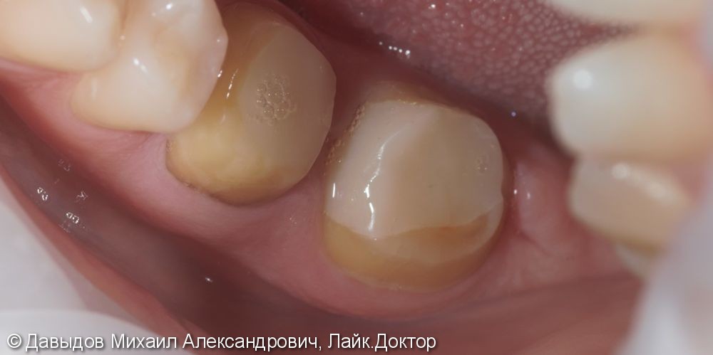 Протезирование жевательных зубов коронками из диоксида циркония - фото №1