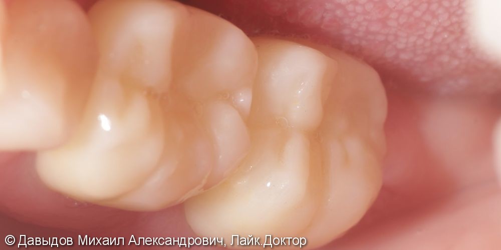 Протезирование жевательных зубов коронками из диоксида циркония - фото №2