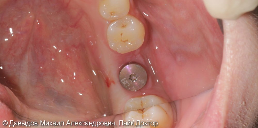 Протезирование включенного дефекта зубного ряда коронкой из диоксида циркония на импланте STRAUMANN - фото №1