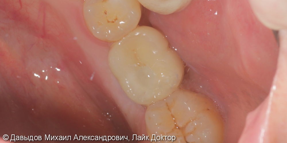 Протезирование включенного дефекта зубного ряда коронкой из диоксида циркония на импланте STRAUMANN - фото №2