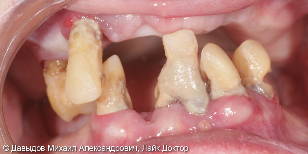 Функциональное протезирование зубов с использованием имплантатов - фото №1