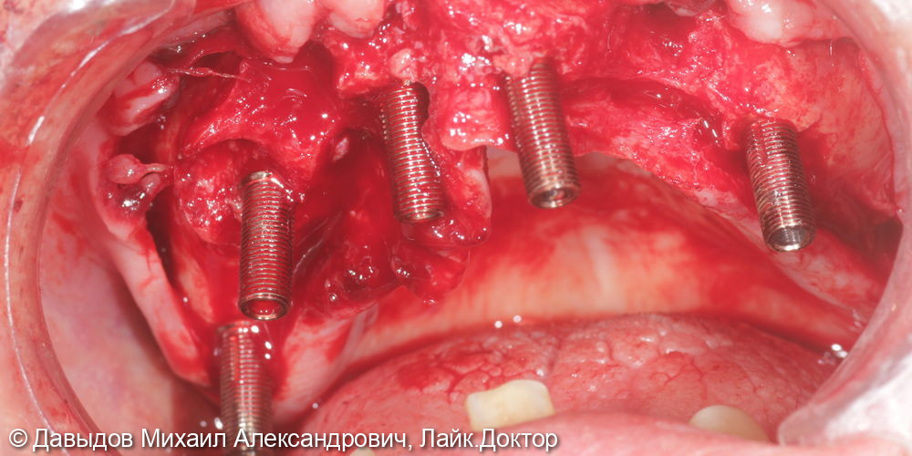 Функциональное протезирование зубов с использованием имплантатов - фото №2