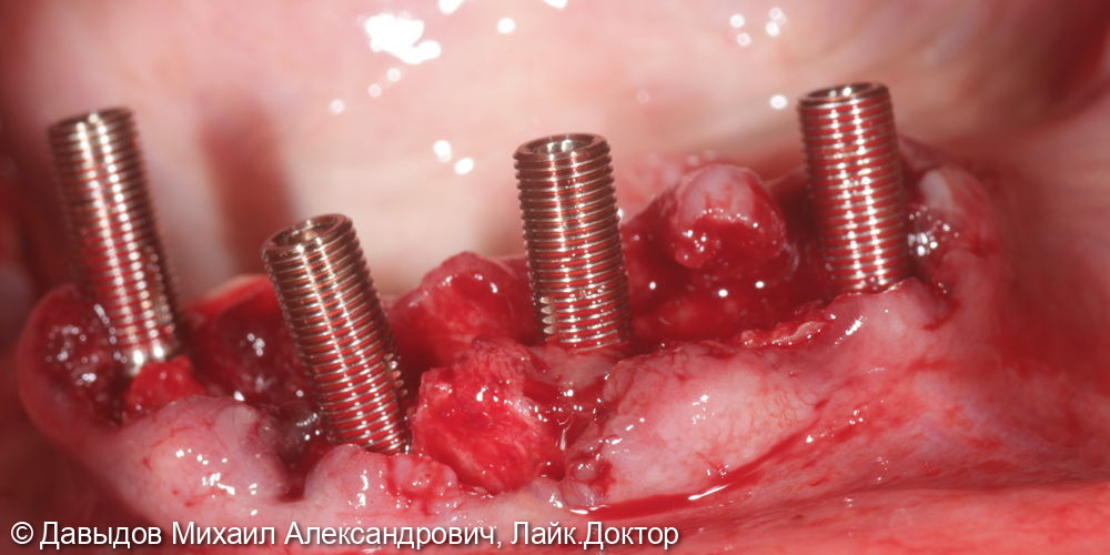 Функциональное протезирование зубов с использованием имплантатов - фото №3