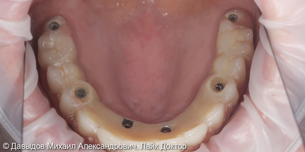 Функциональное протезирование зубов с использованием имплантатов - фото №5
