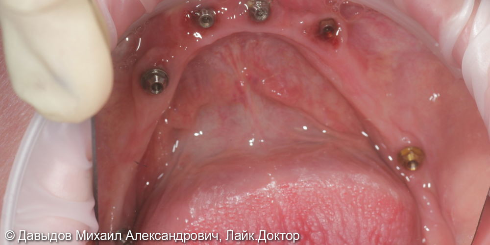Функциональное протезирование зубов с использованием имплантатов - фото №6