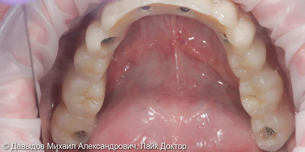Функциональное протезирование зубов с использованием имплантатов - фото №7