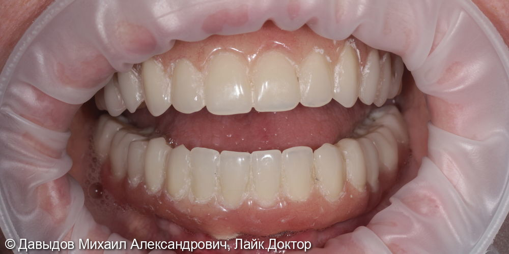 Функциональное протезирование зубов с использованием имплантатов - фото №8