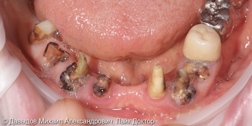 Протезирование зубов нижней челюсти иеталлоакриловым протезом на фрезерованной балке с уровня мультиюнитов на 6ти имплантах - фото №1