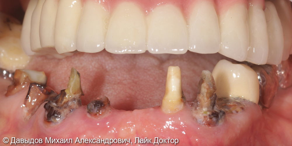 Протезирование зубов нижней челюсти иеталлоакриловым протезом на фрезерованной балке с уровня мультиюнитов на 6ти имплантах - фото №2