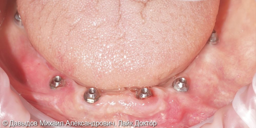 Протезирование зубов нижней челюсти иеталлоакриловым протезом на фрезерованной балке с уровня мультиюнитов на 6ти имплантах - фото №3