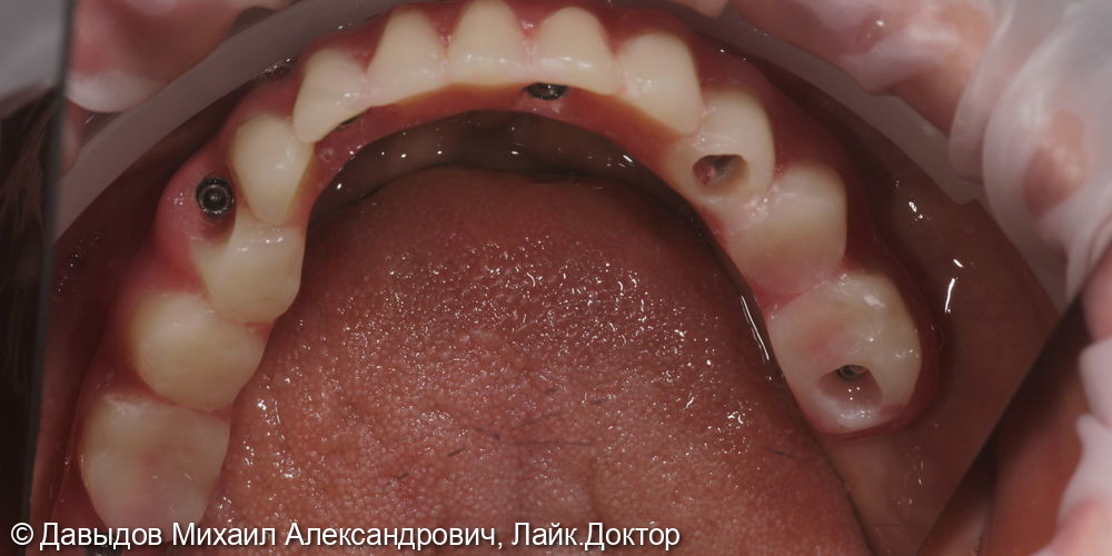 Протезирование зубов нижней челюсти иеталлоакриловым протезом на фрезерованной балке с уровня мультиюнитов на 6ти имплантах - фото №4