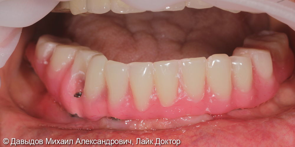Протезирование зубов нижней челюсти иеталлоакриловым протезом на фрезерованной балке с уровня мультиюнитов на 6ти имплантах - фото №5