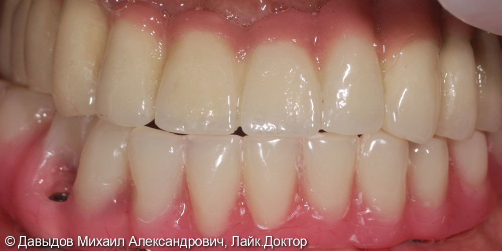Протезирование зубов нижней челюсти иеталлоакриловым протезом на фрезерованной балке с уровня мультиюнитов на 6ти имплантах - фото №6